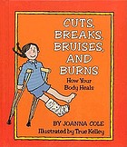 Cuts, breaks, bruises, and burns : how your body heals