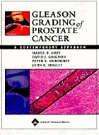 Gleason grading prostatic adenocarcinoma