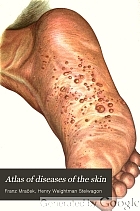 Atlas of diseases of the skin, including an epitome of pathology and treatment,